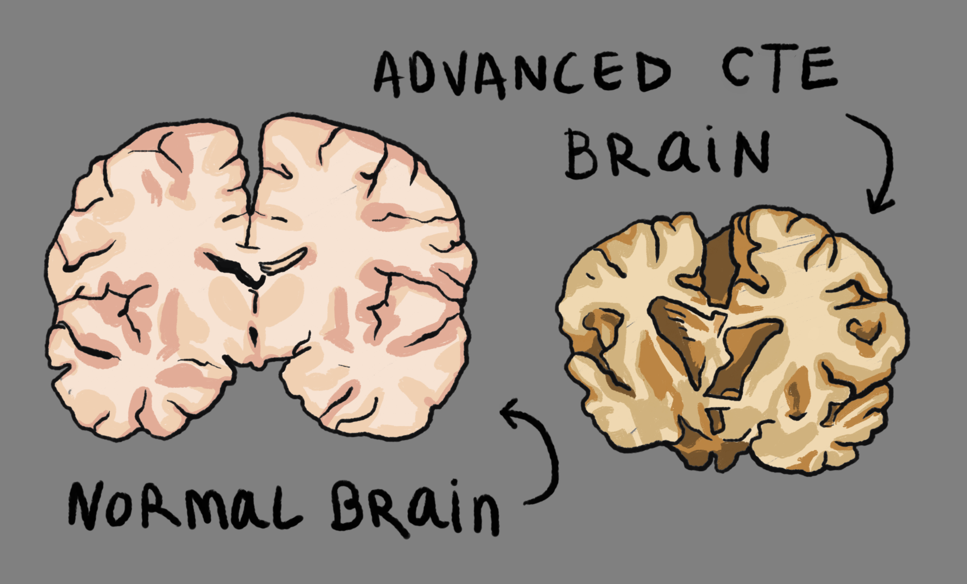 CTE head injuries and the Women's World Cup